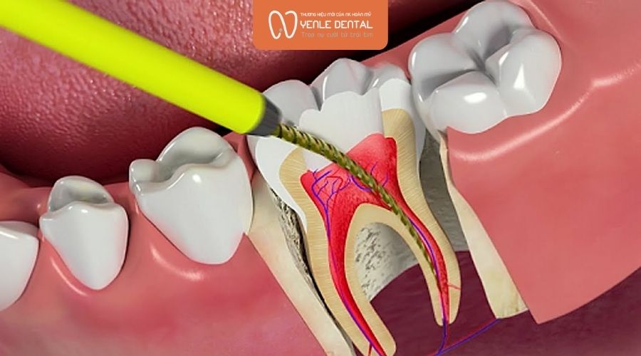 Lựa chọn địa chỉ chữa tuỷ răng uy tín